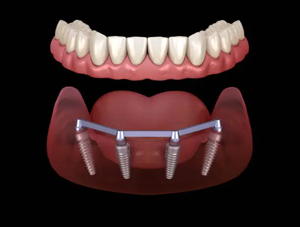 All on X dental implants | Kalm Dental Care