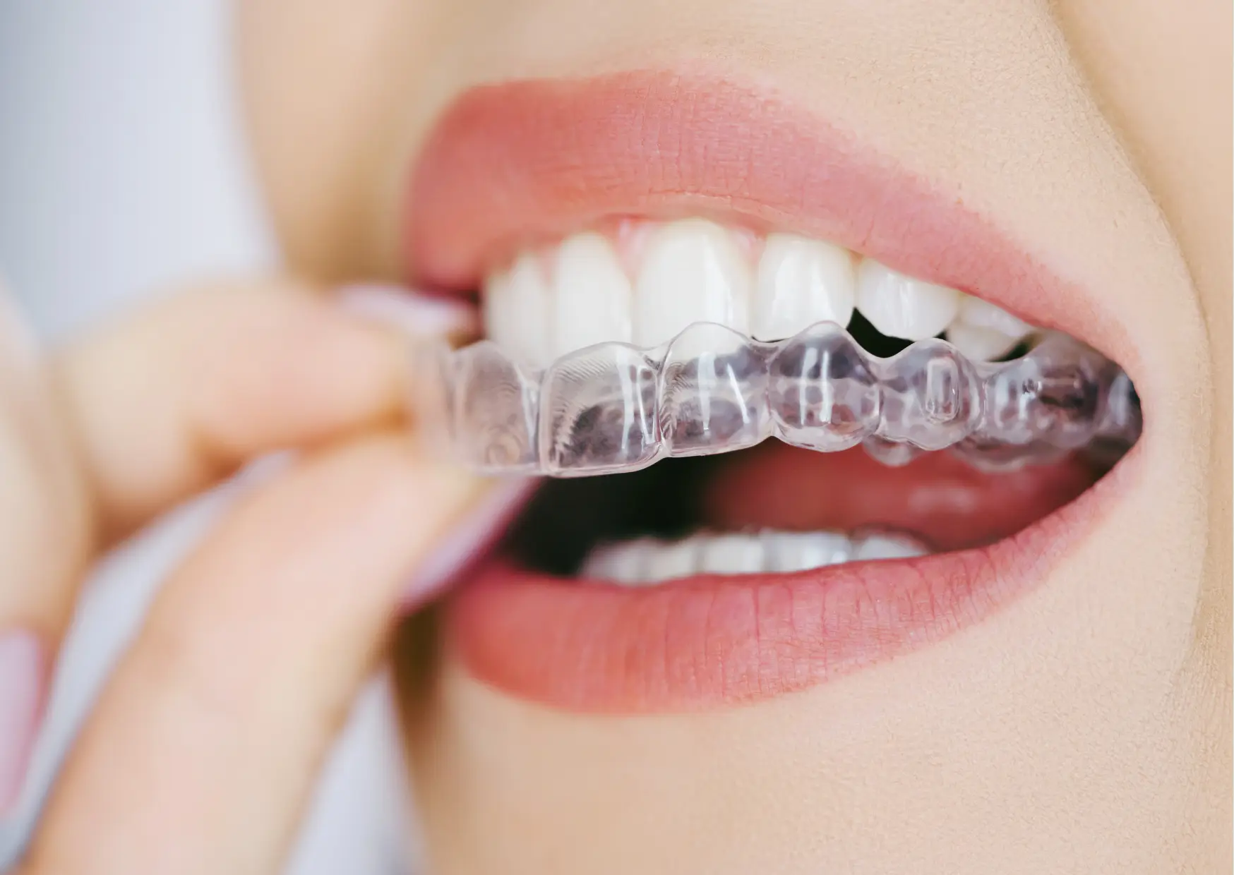 Aligner Kalm Dental Care