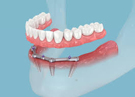 All-on-4 dental Implants