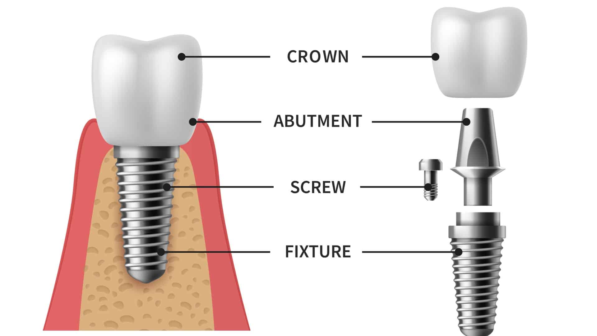 Dental Implant