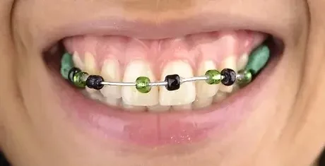 fake braces dangers