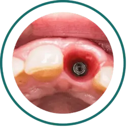 Dental Bali prices - Dental Implant | kalm Dental Care