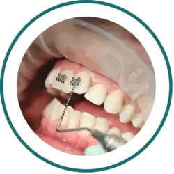 Dental Bali prices - Braces | kalm Dental Care