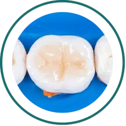 Bali dentist price list - Tooth Filling | Kalm Dental Care