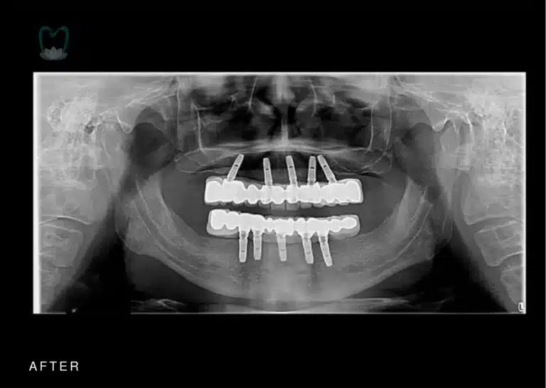 Full mouth Dental Implants cost Bali | kalm Dental Care