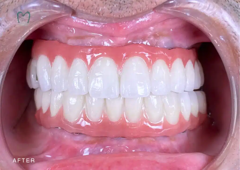Full mouth Dental Implants cost Bali | kalm Dental Care