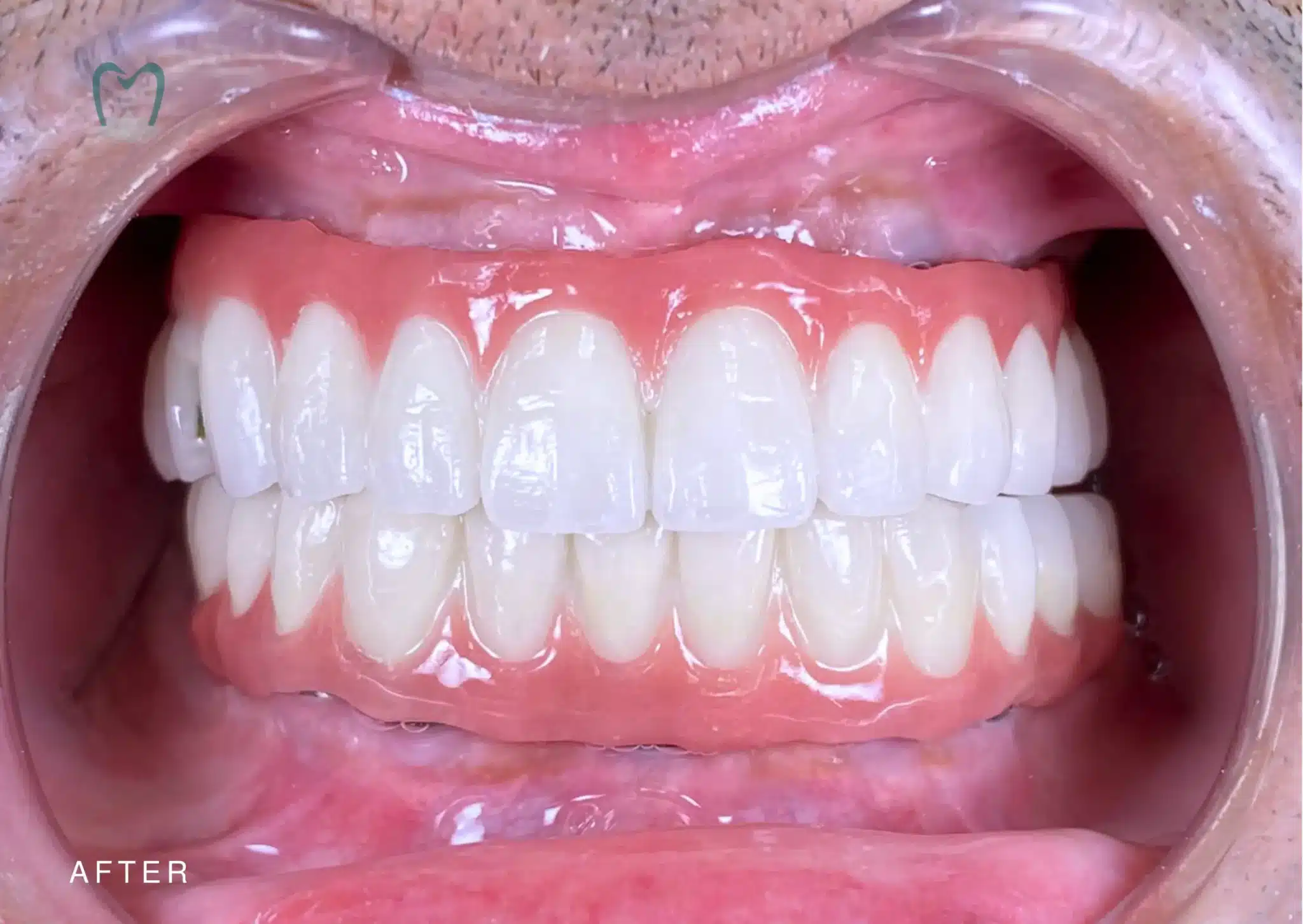 Full mouth Dental Implants cost Bali | kalm Dental Care