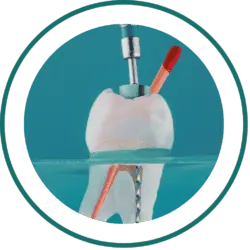 Dental Bali prices - Root Canal treatment | kalm Dental Care