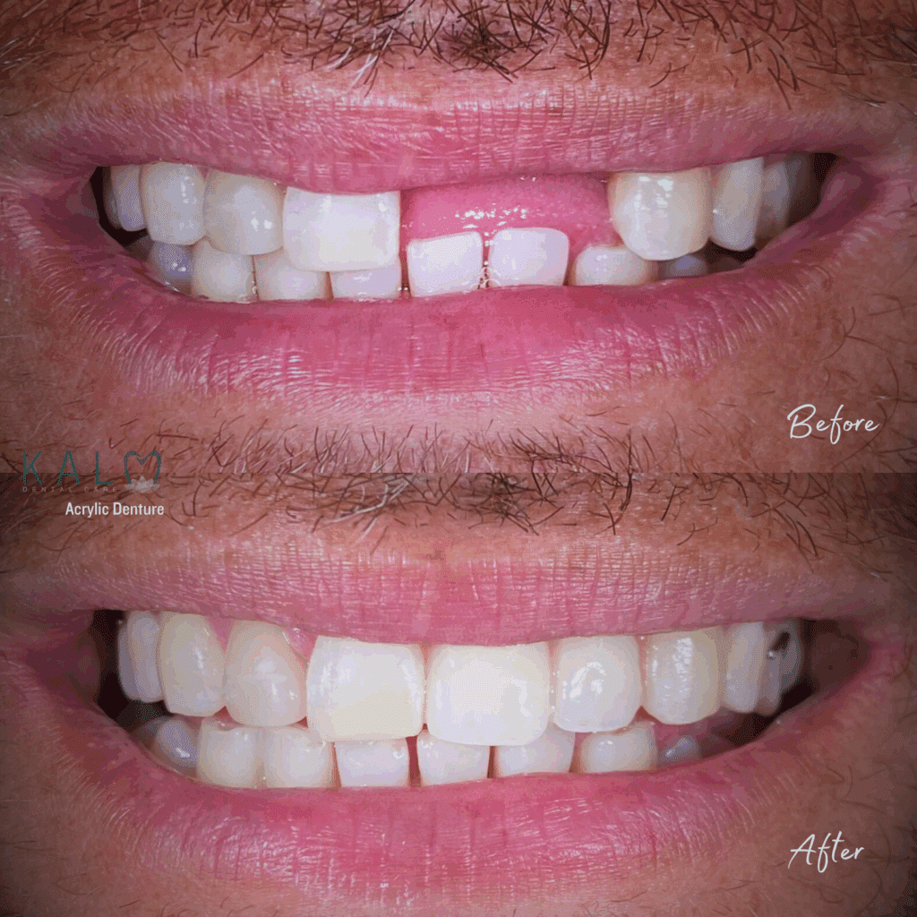 Dentures in bali | Kalm Dental Care