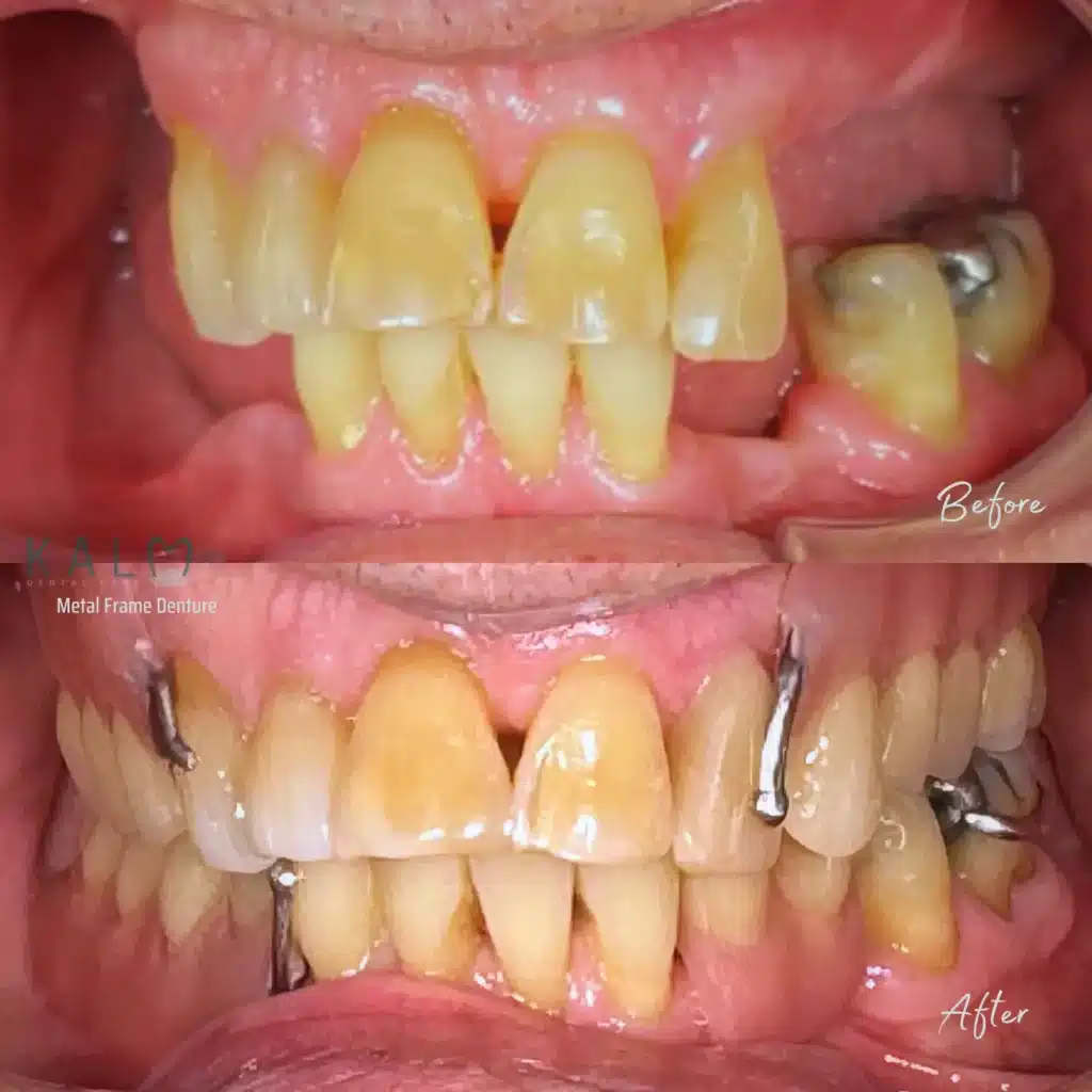 Acrylic Denture (2)