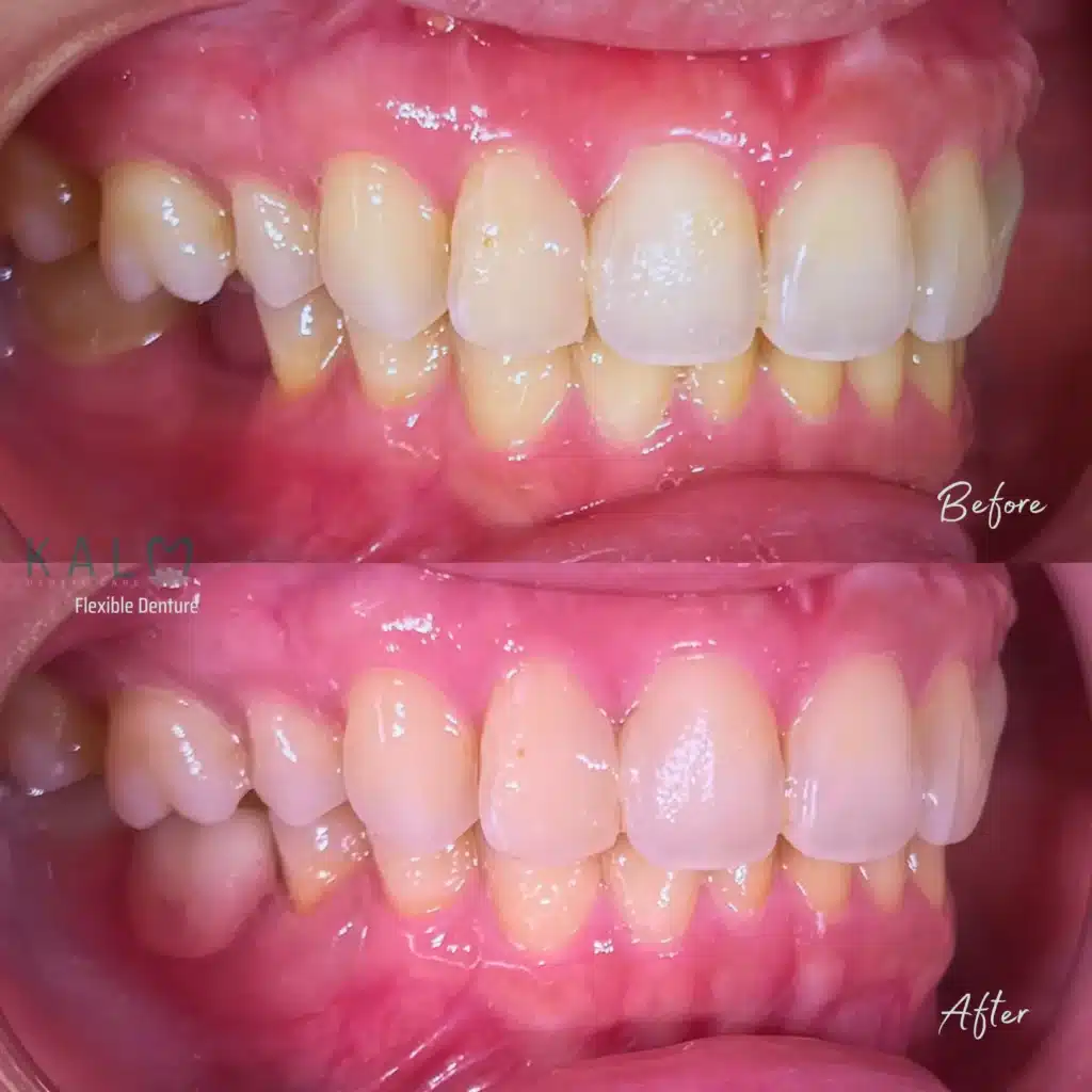 Acrylic Denture (3)