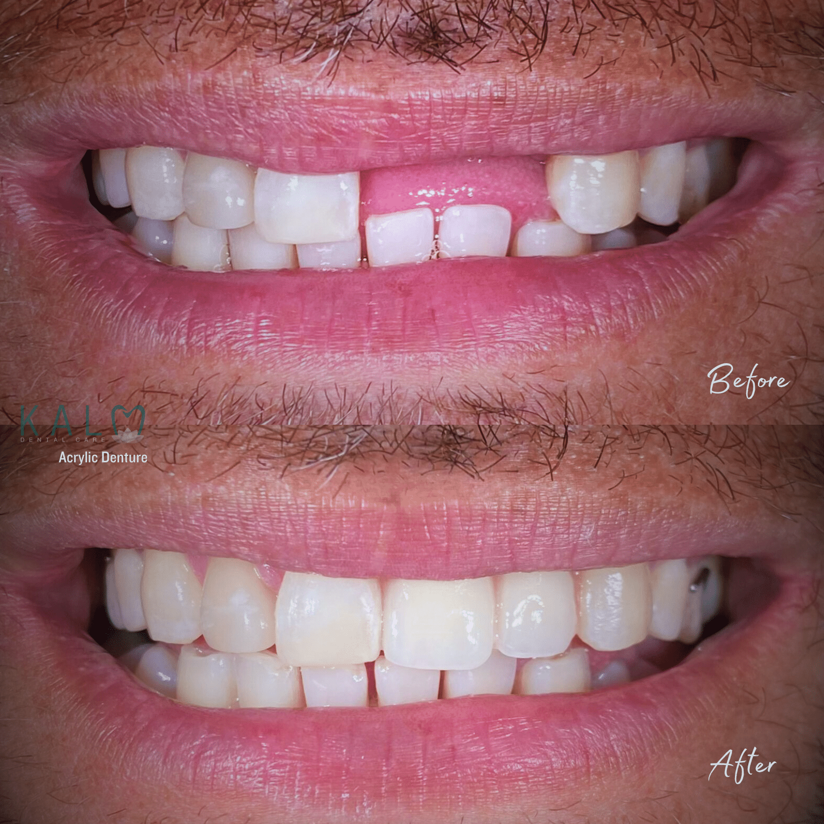 Dentures in bali | Kalm Dental Care