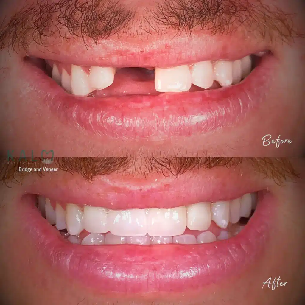 Bridge and Veneer