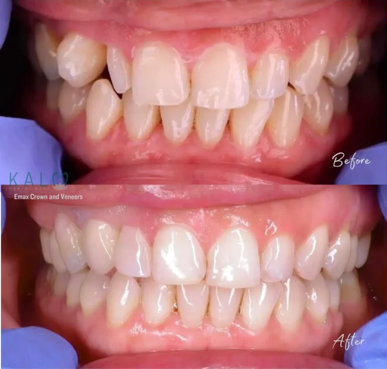 dental crowns bali