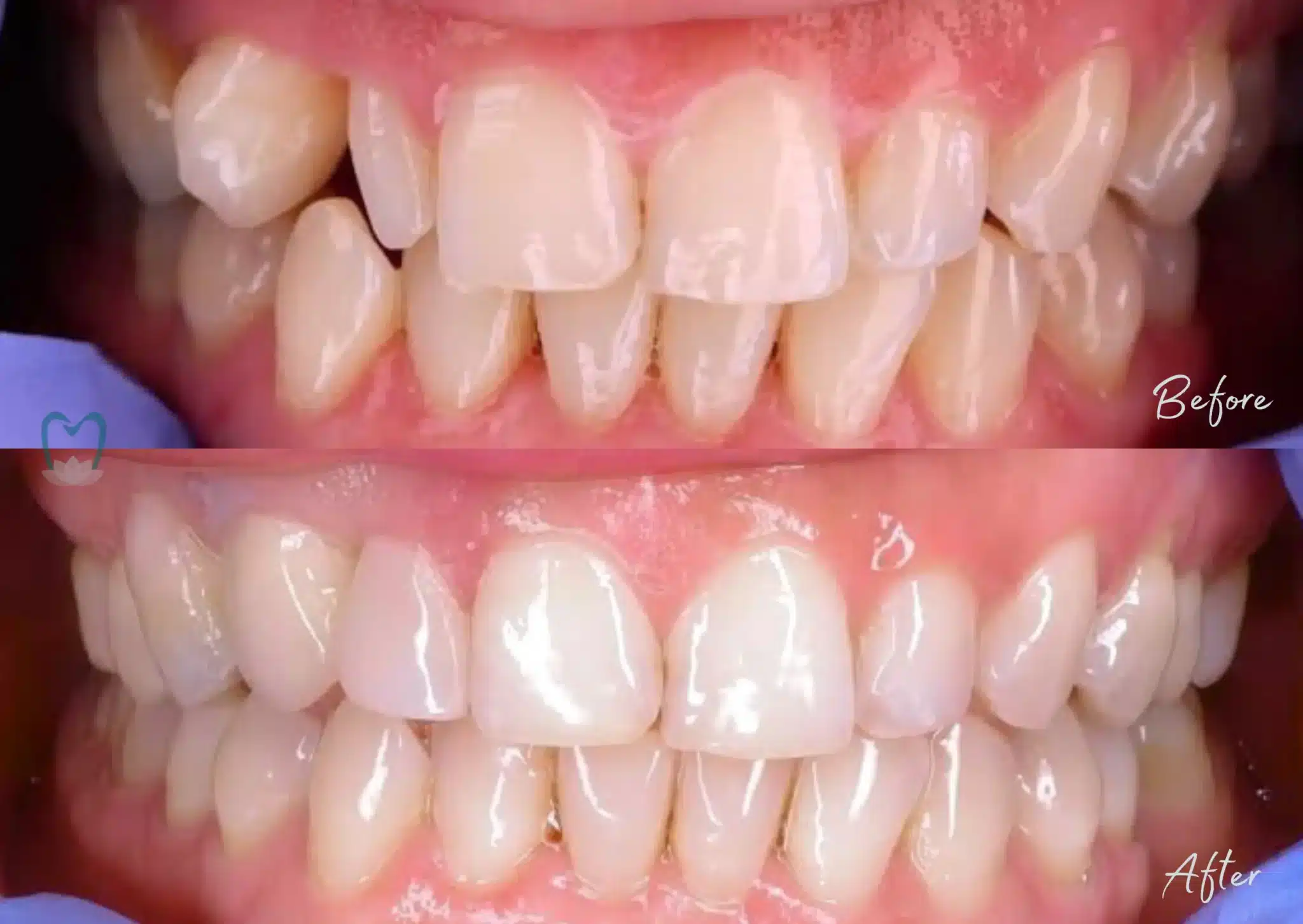 Dental Crown Cost Bali | Kalm Dental Care