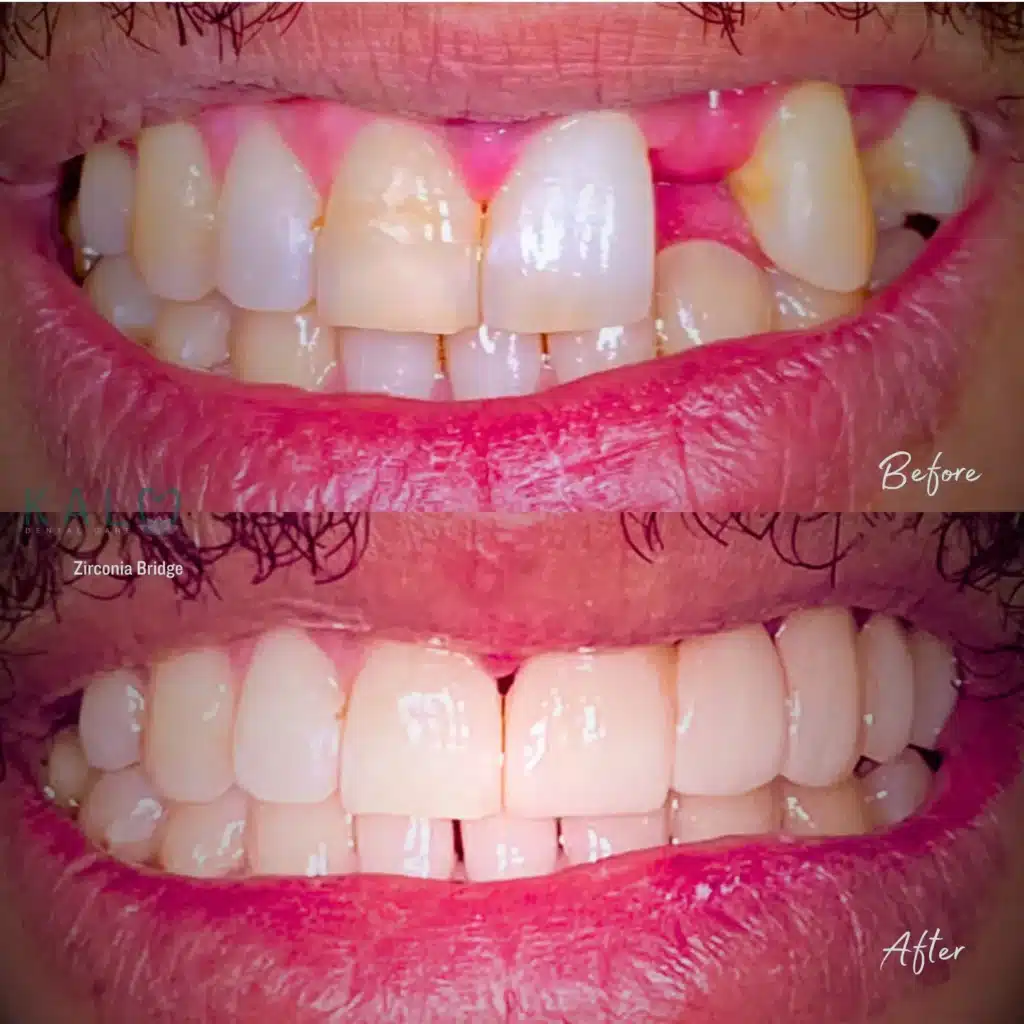 Zirconia Bridge