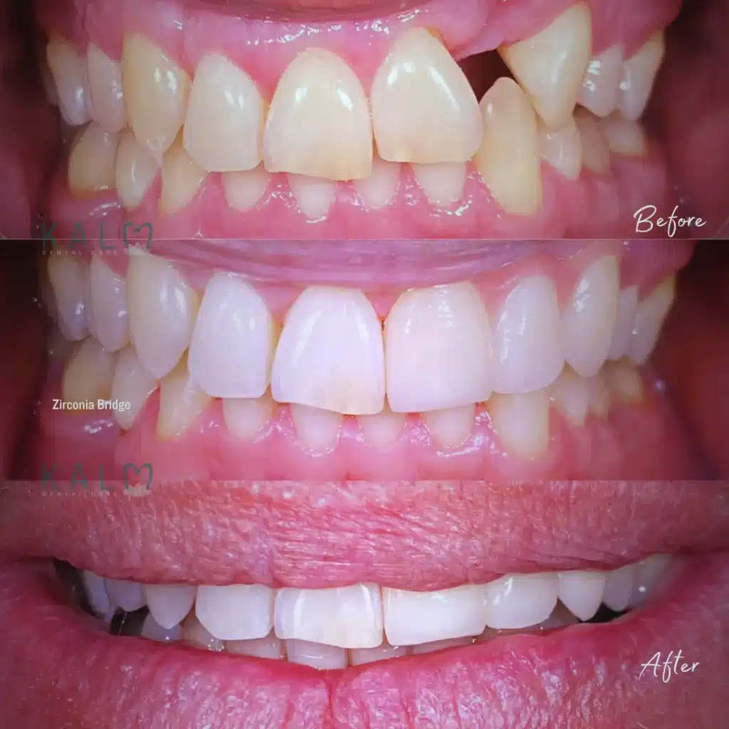 Zirconia Bridge (3)