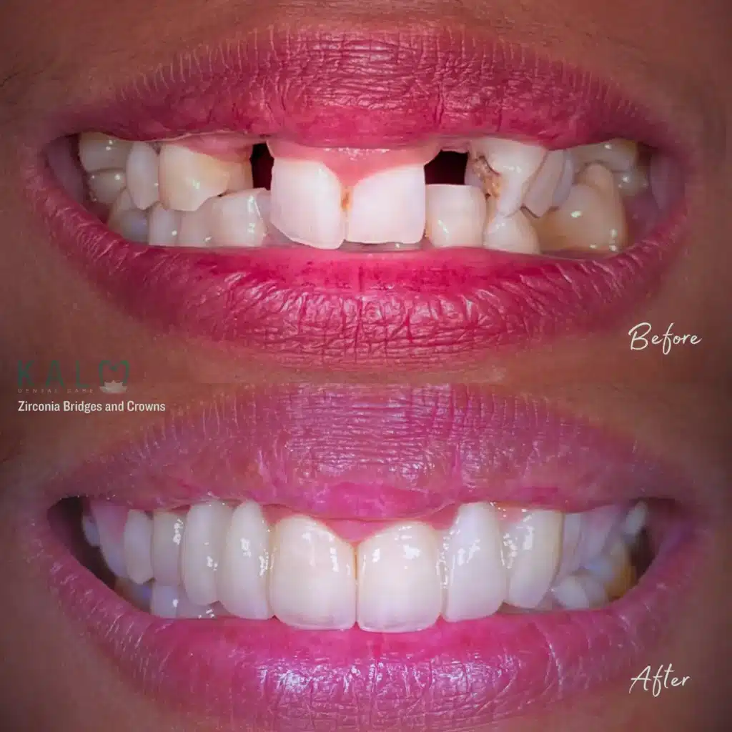 Zirconia Bridges and Crowns