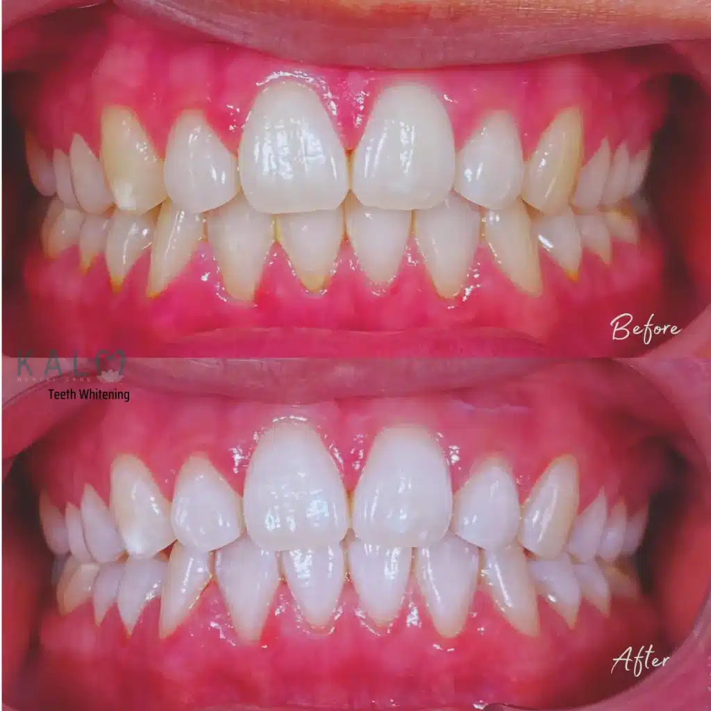 Teeth whitening