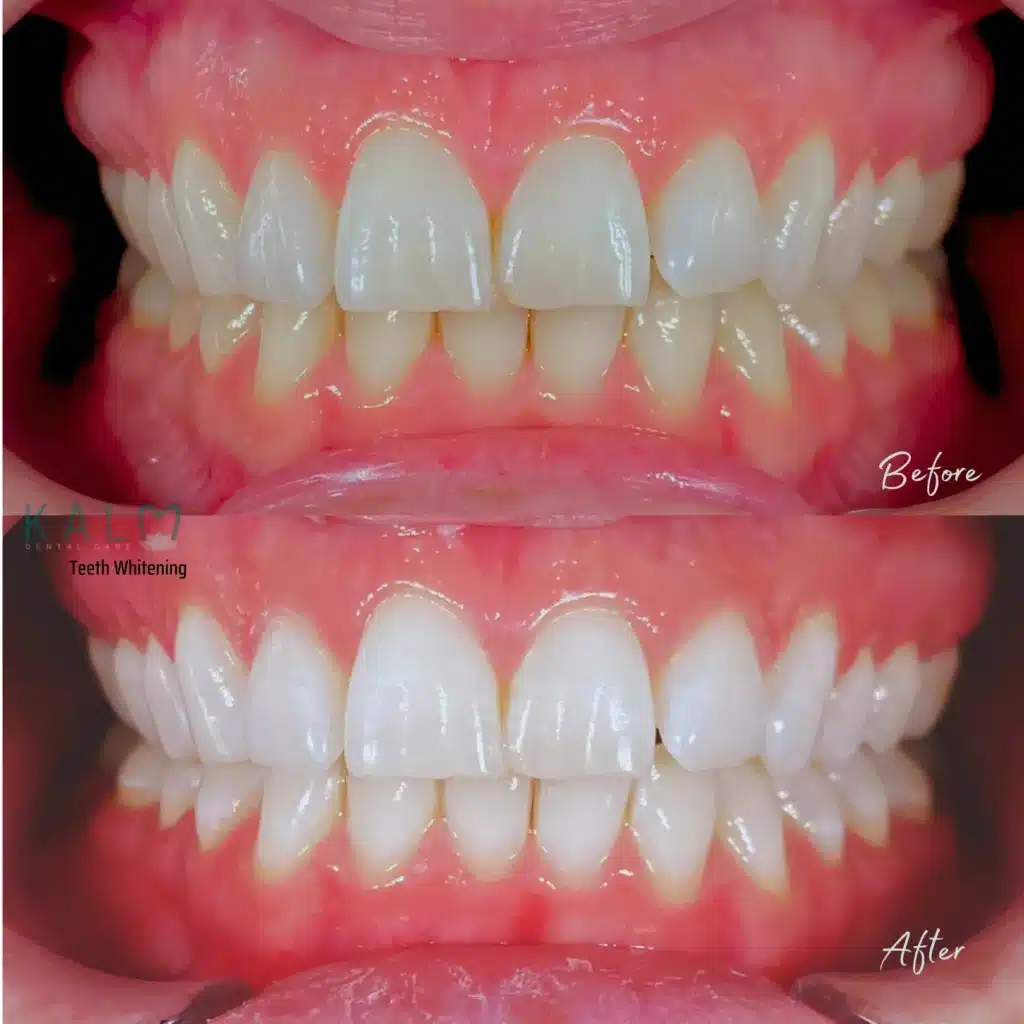 Bali Teeth whitening
