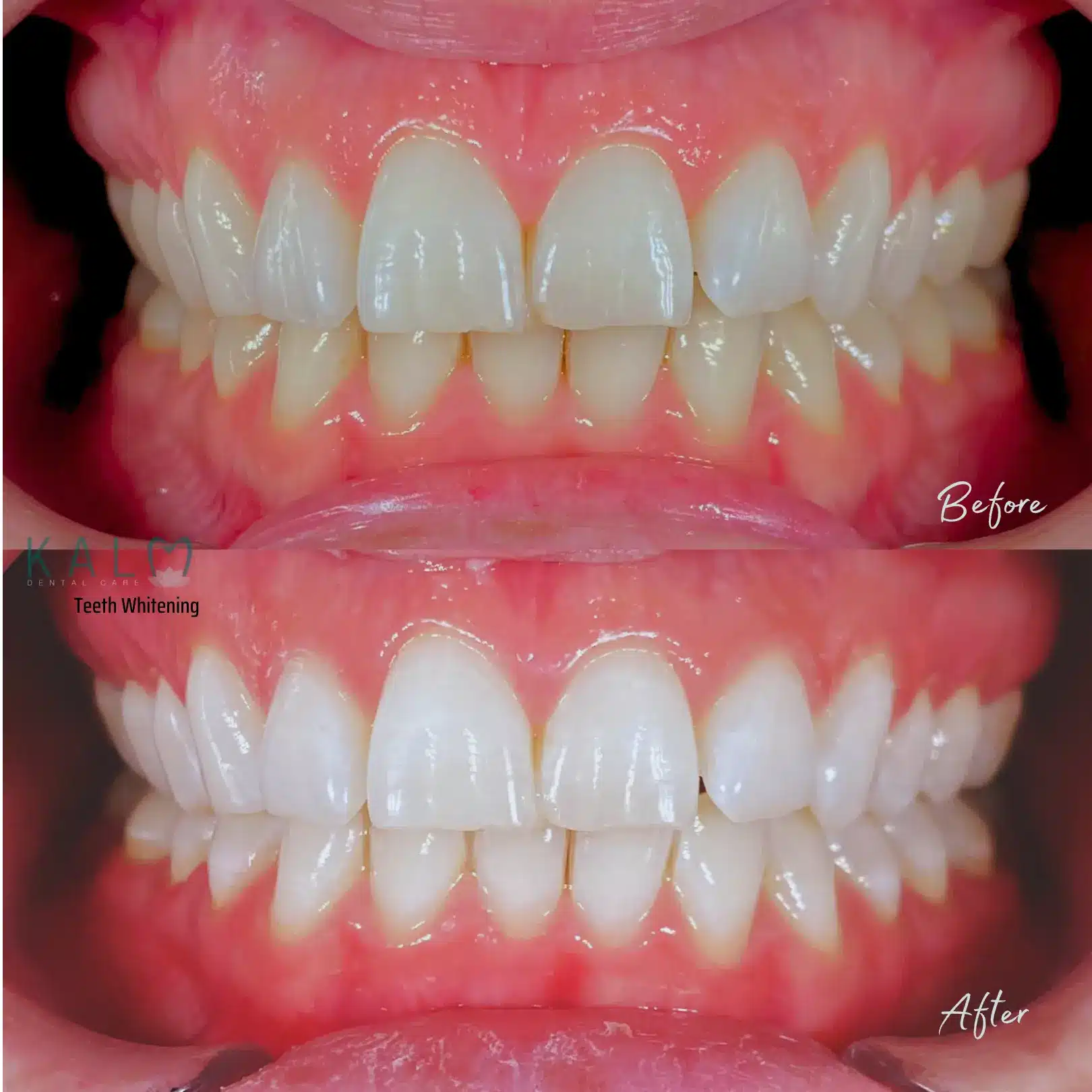 Bali Teeth whitening