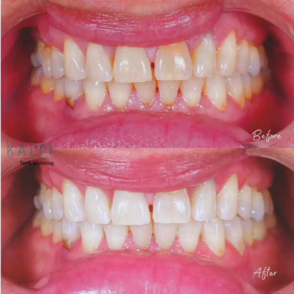 Teeth whitening (4)