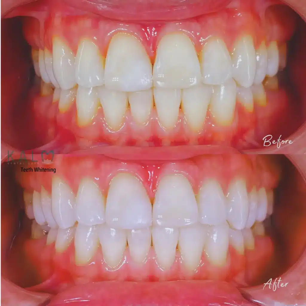 Teeth whitening (5)