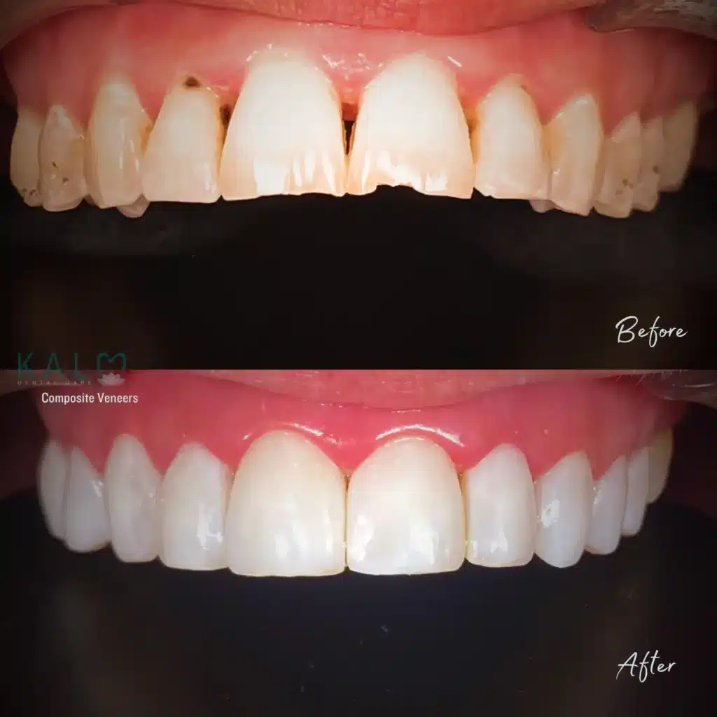 What are Dental Veneers