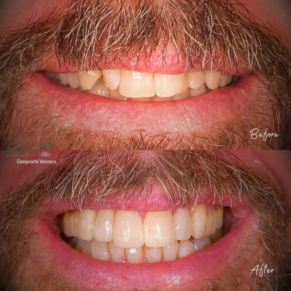 What are Dental Veneers