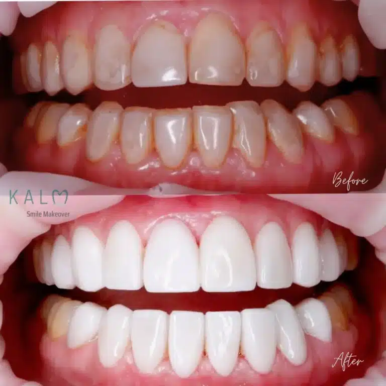 smile makeover bali