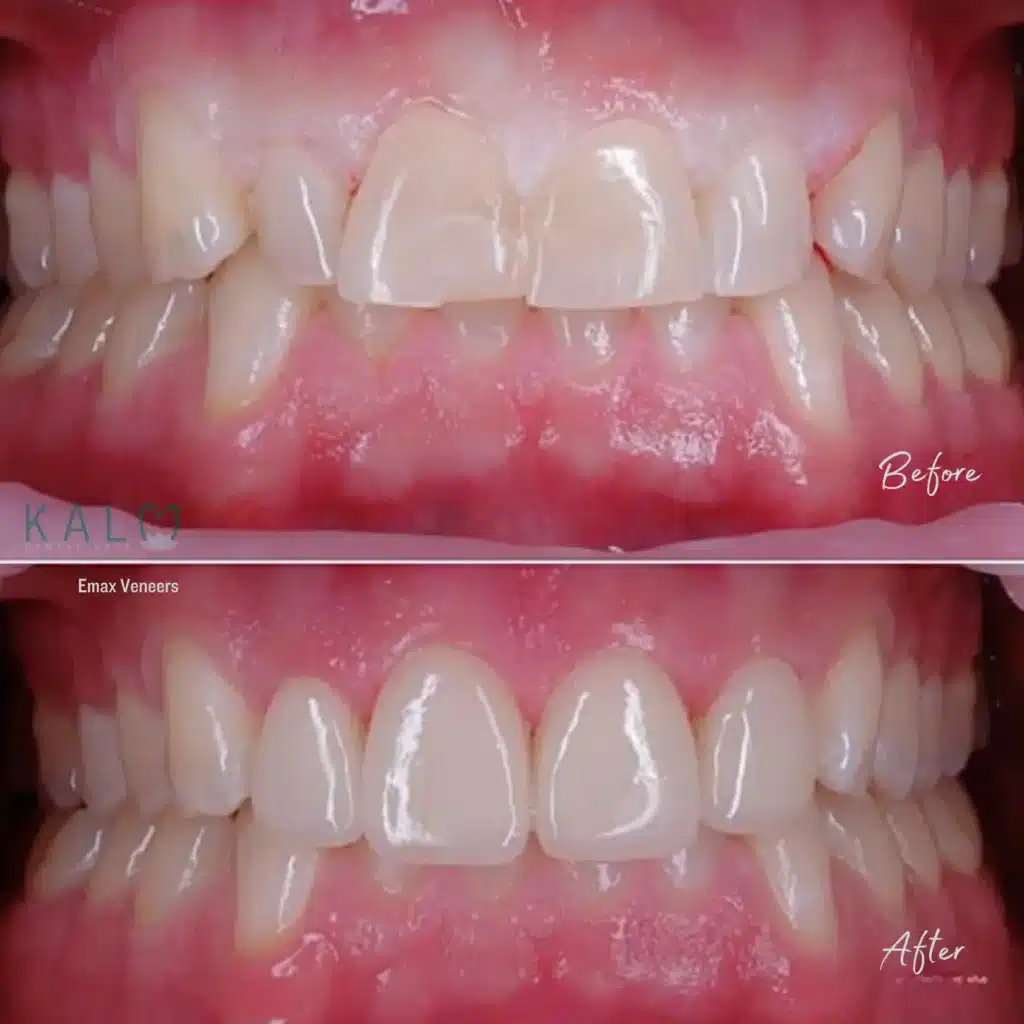 What are Dental Veneers