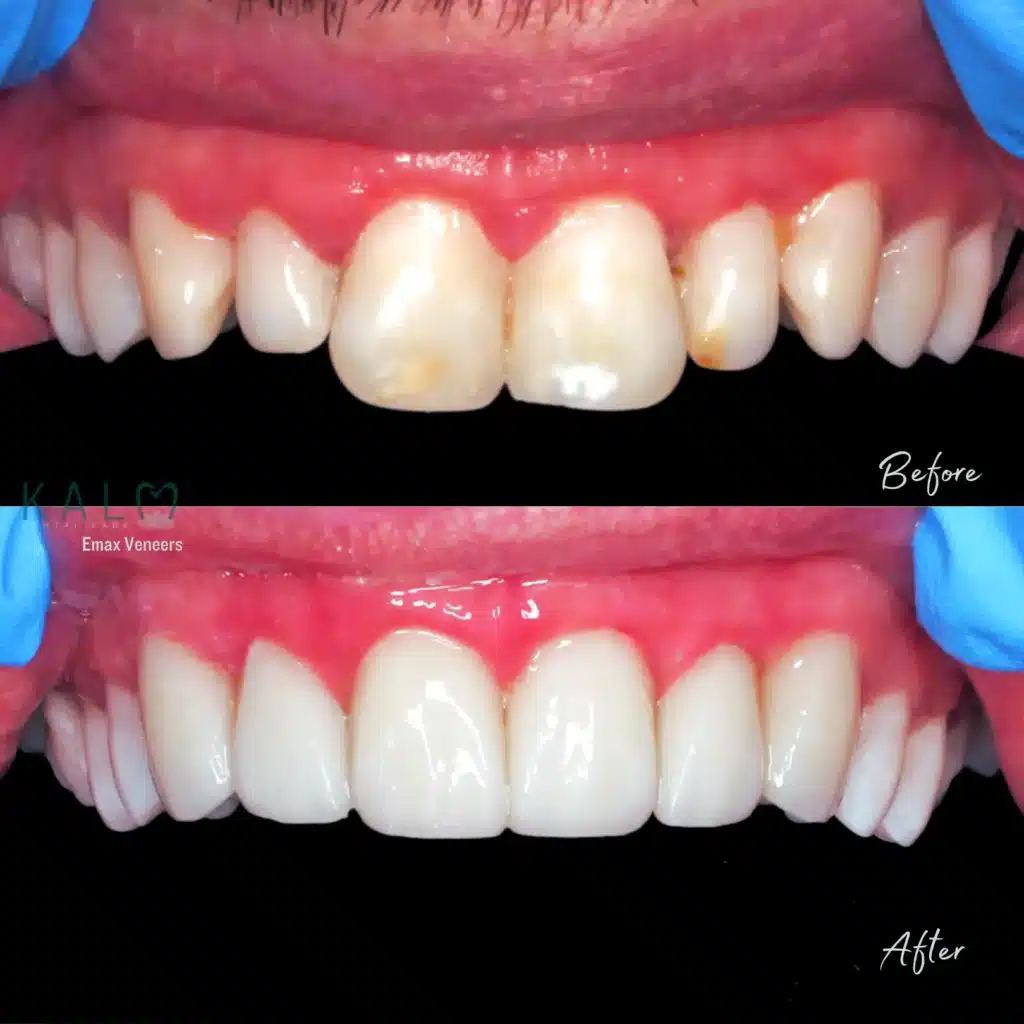 What are Dental Veneers