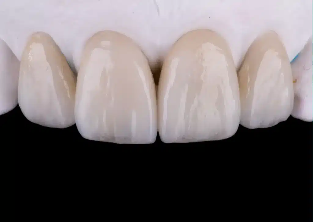What are Dental Veneers