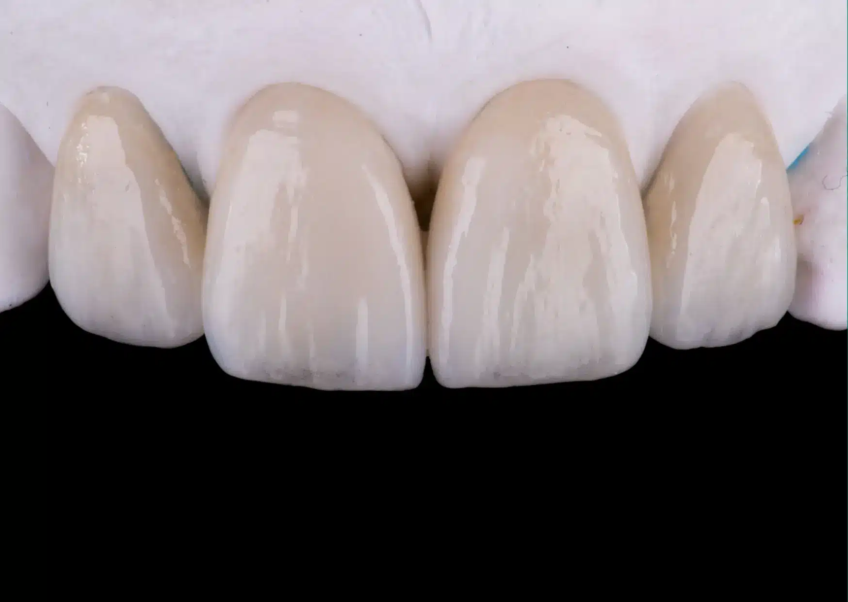 What are Dental Veneers