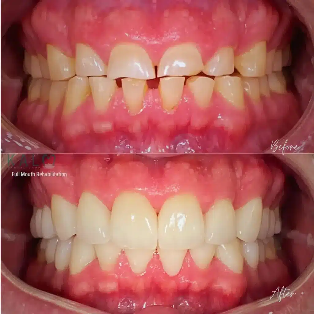 full mouth rehabilitation bali