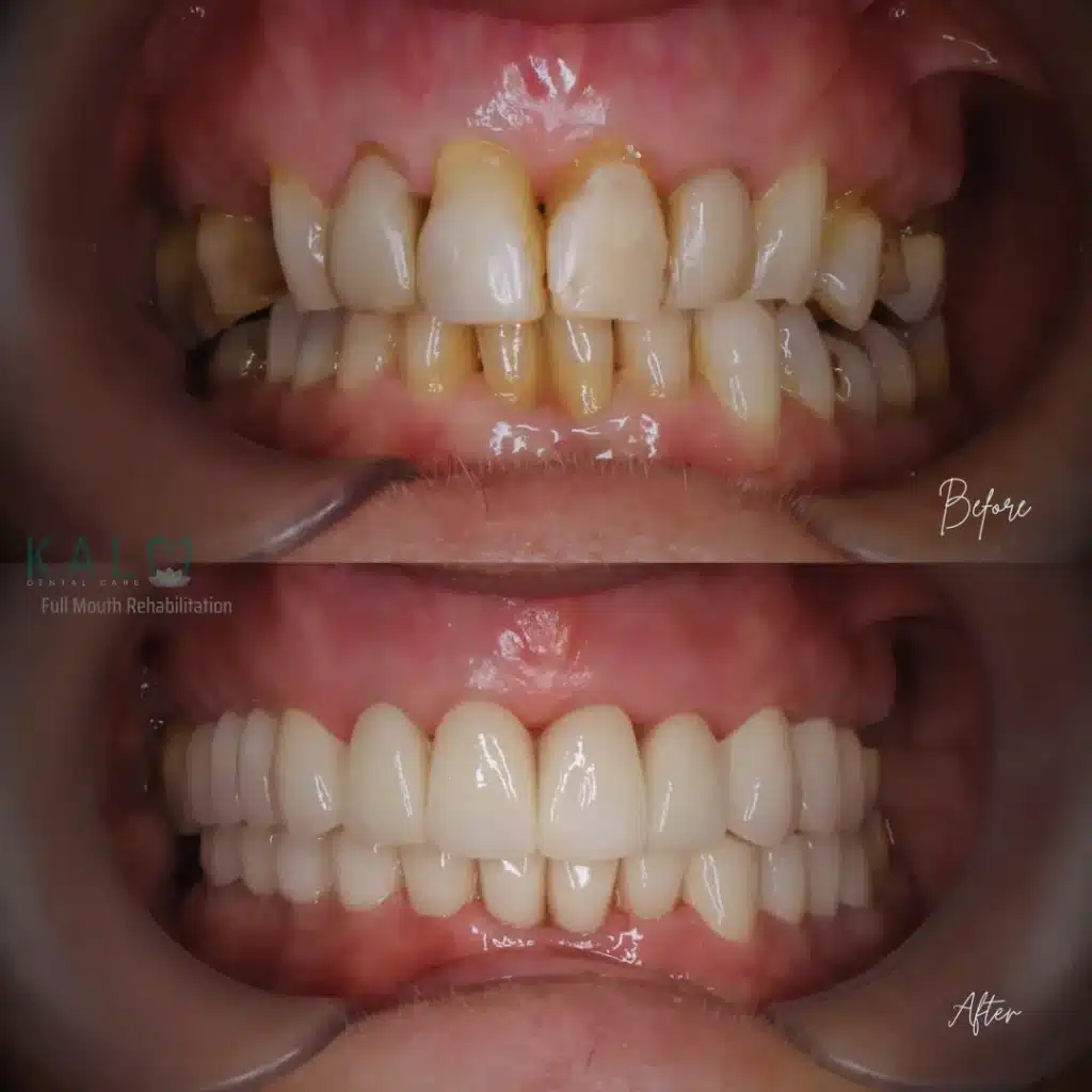 full mouth rehabilitation bali