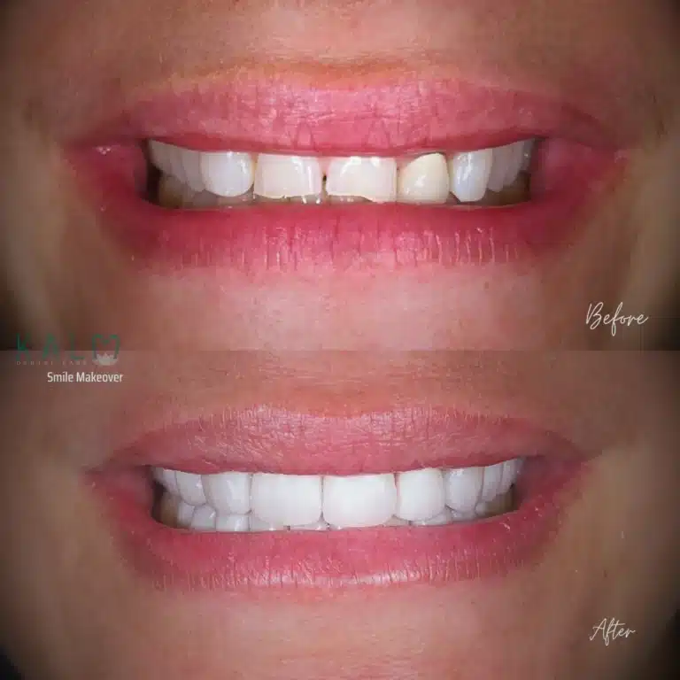 smile makeover bali