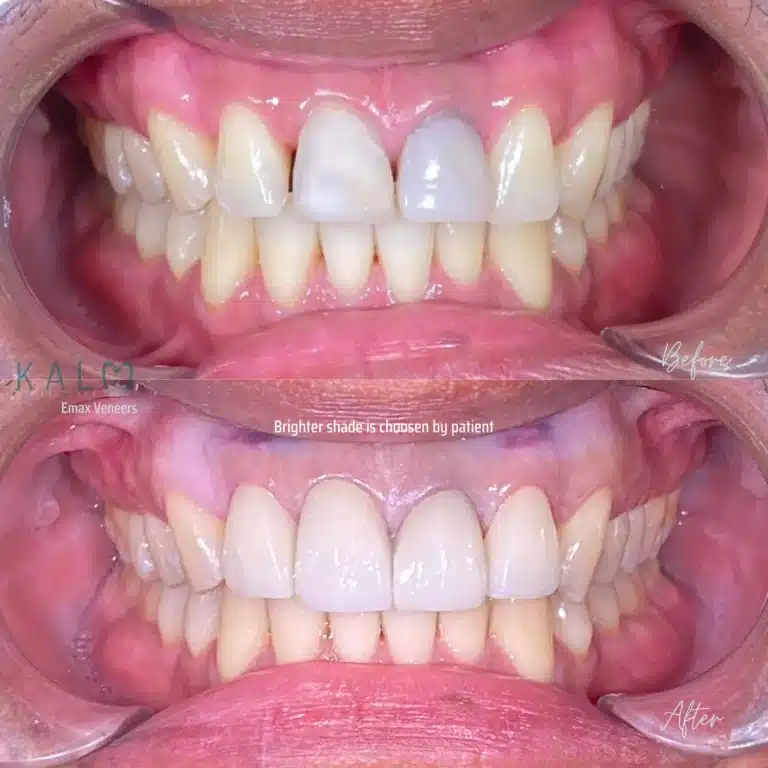 smile makeover bali