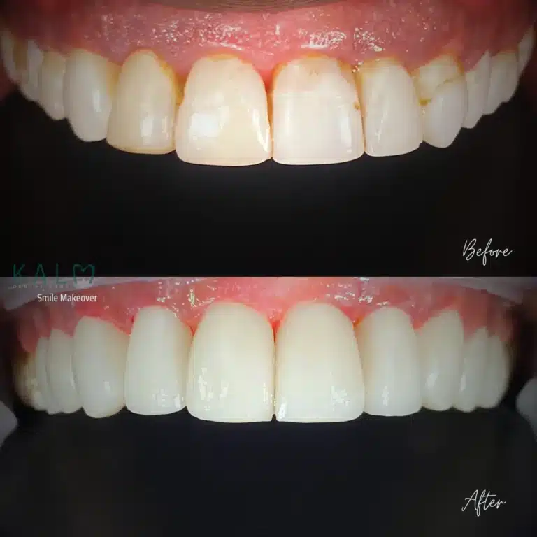 smile makeover bali