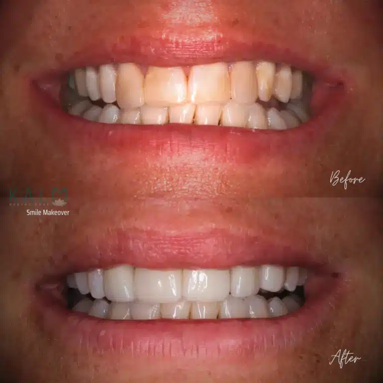 smile makeover bali
