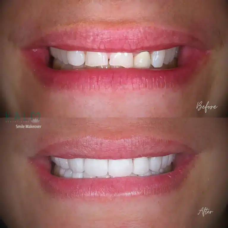 veneers bali