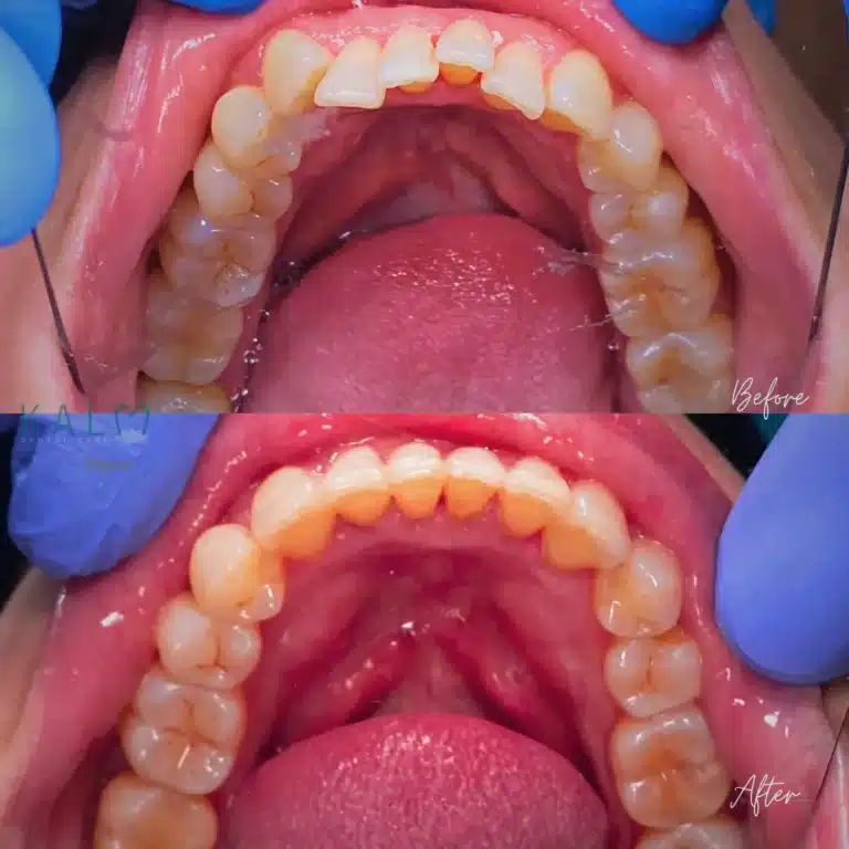 Aligners Bali