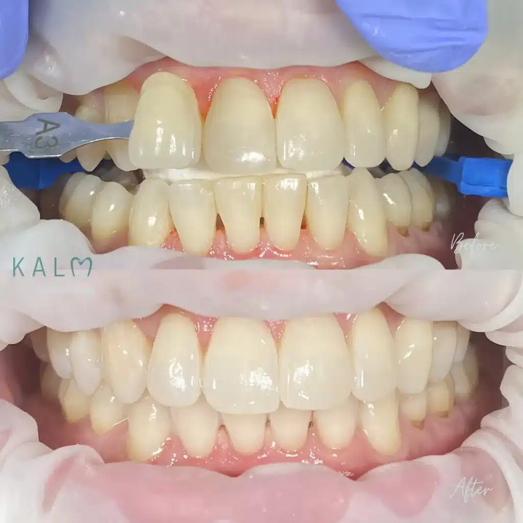 Teeth Whitening Bali