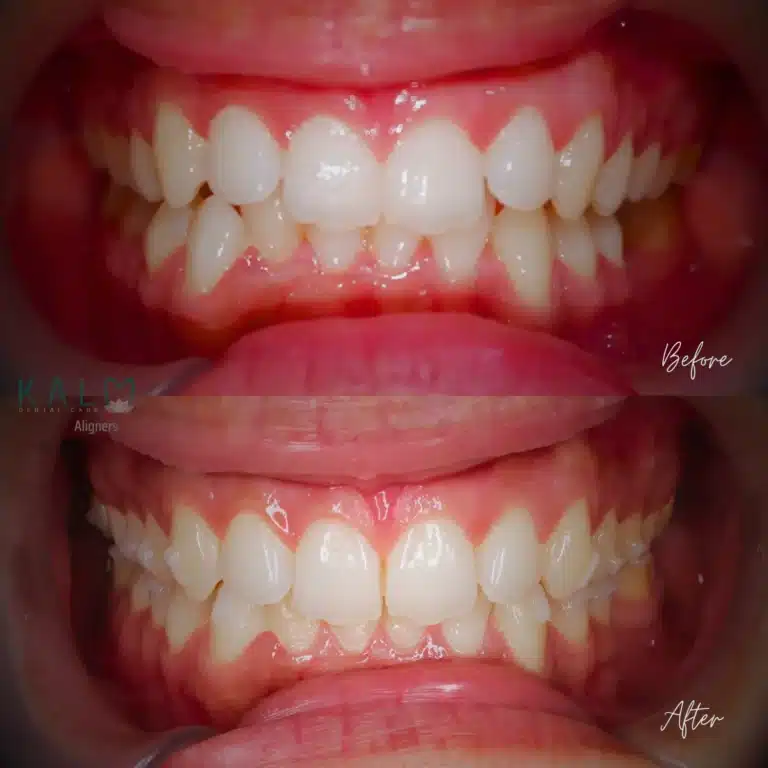Aligners Bali