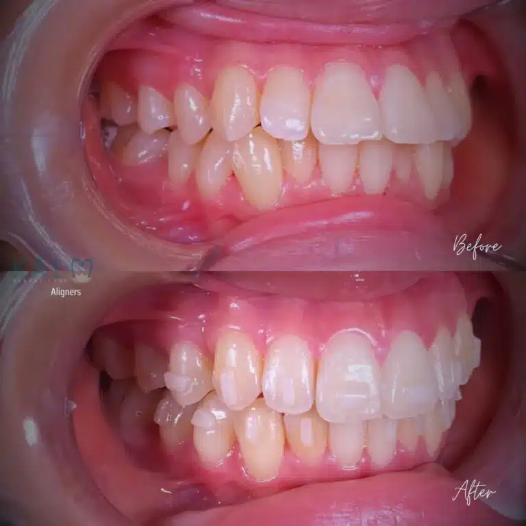 Aligners Bali