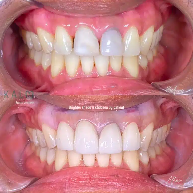 Emax Veneers Bali