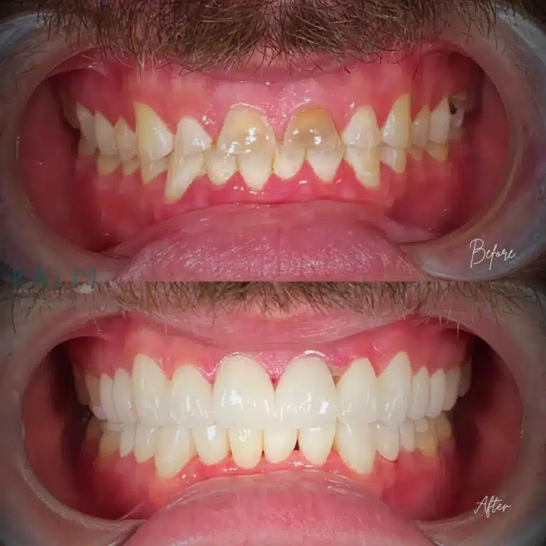 Full Mouth Rehabilitation Bali