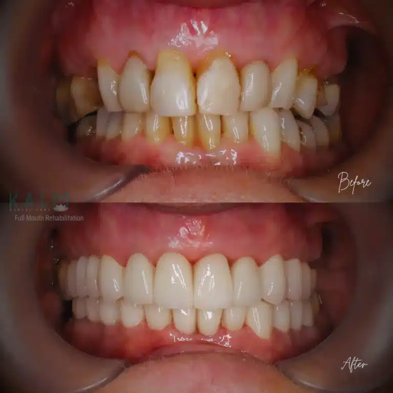 Full Mouth Rehabilitation