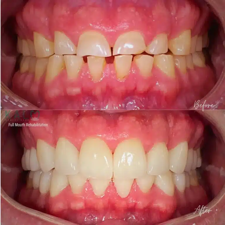 Full Mouth Rehabilitation Bali
