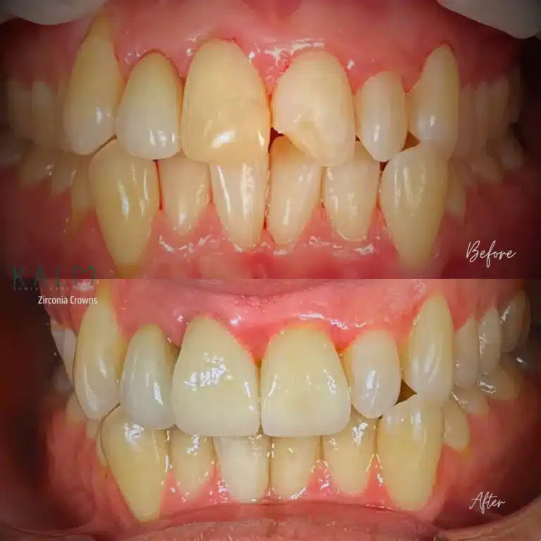 Zirconia Crown in Bali